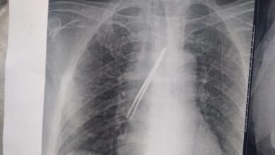 استخراج « ملقاط شعر» من قصبة هوائية لمريض ببنها 