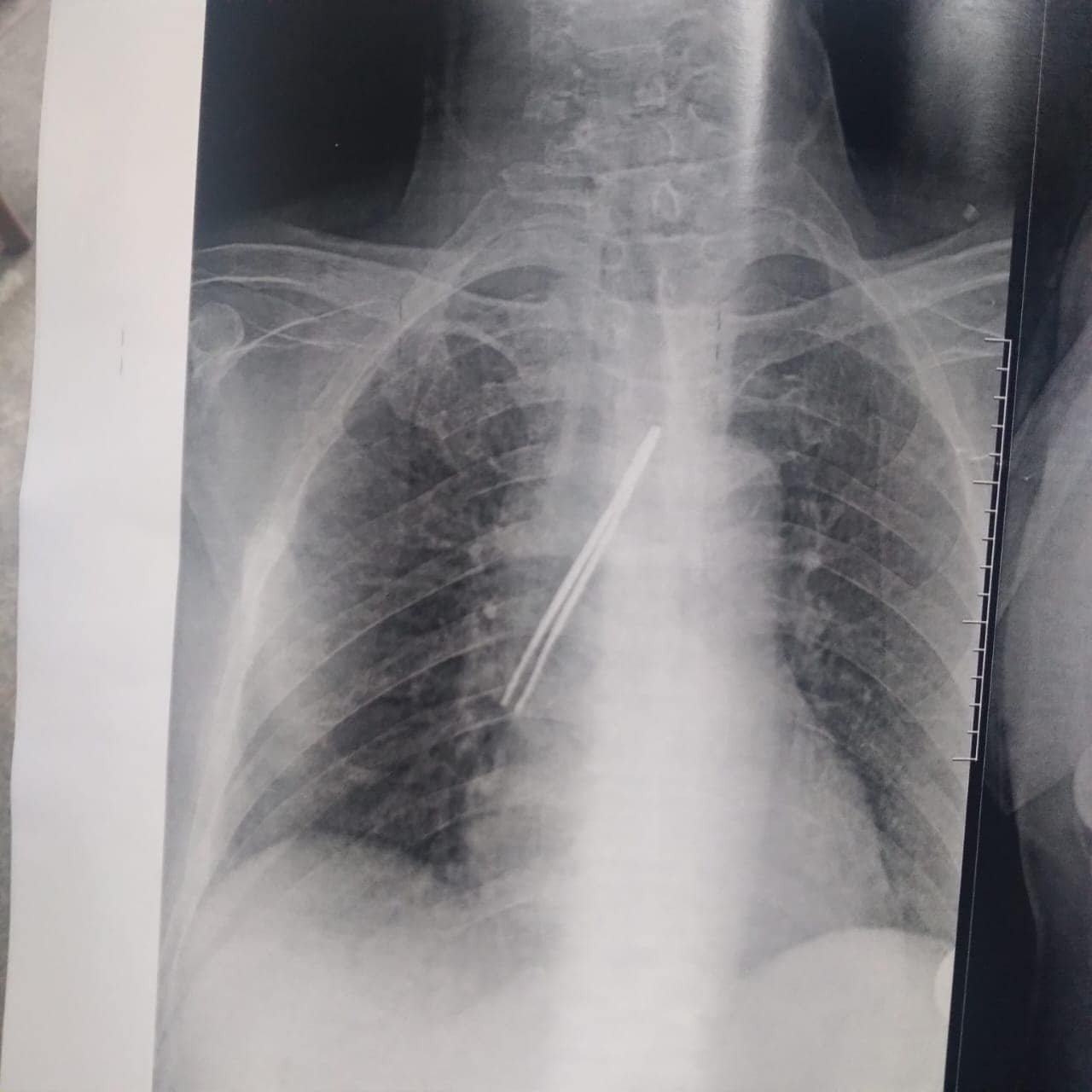 استخراج « ملقاط شعر» من قصبة هوائية لمريض ببنها