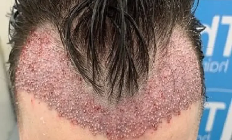 زراعة الشعر
