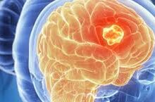اعراض سرطان المخ