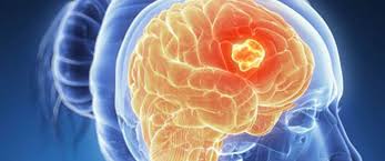اعراض سرطان المخ